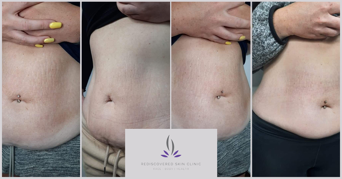 Showing before and afters of Fractional Laser on Stretch Marks