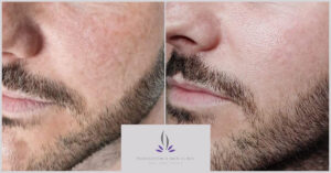 Showing before and after on laser for pigmentation
