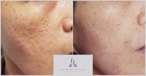 Showing before and after of fractional laser on acne scarring