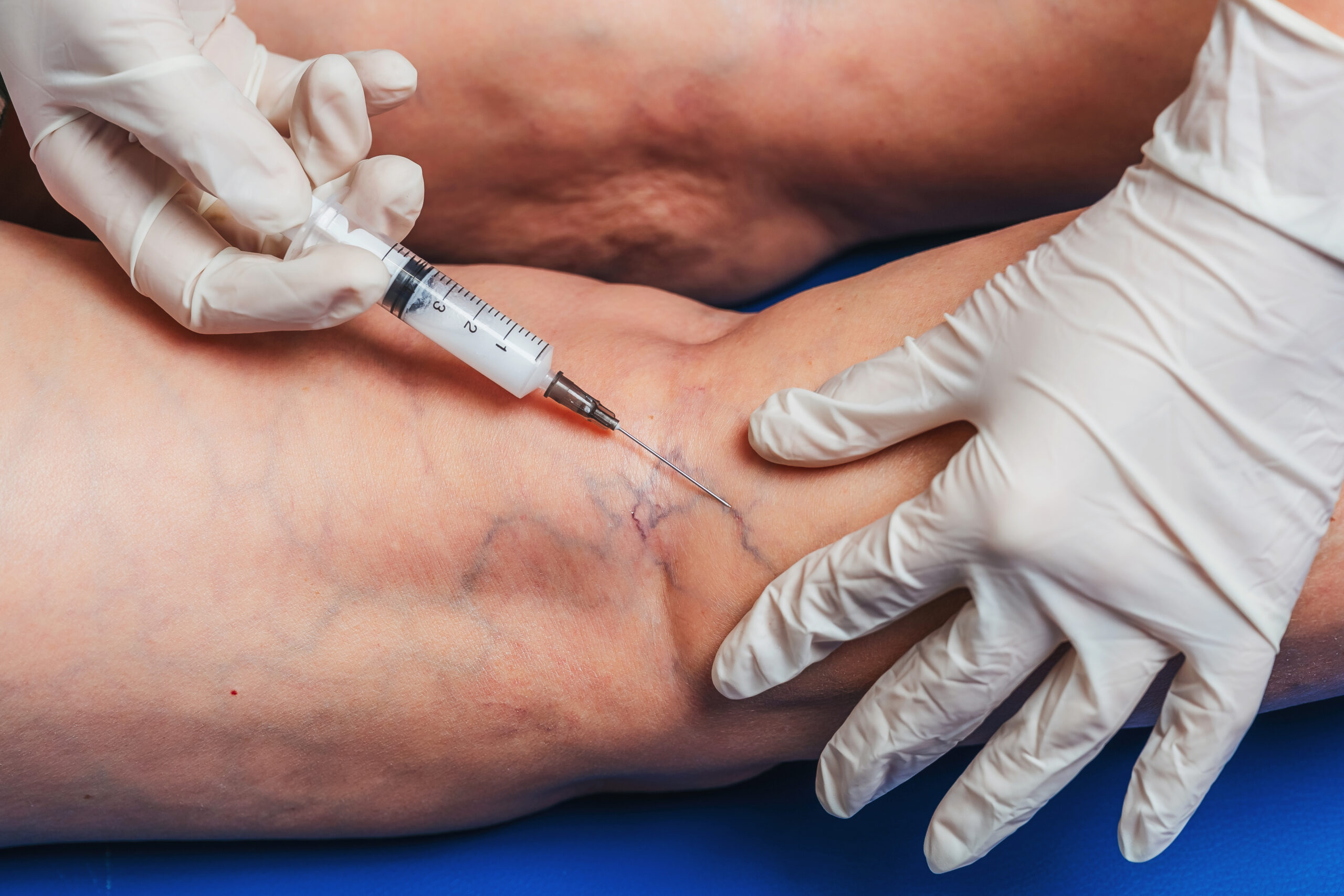 Injections into the veins of an elderly woman's leg close-up.