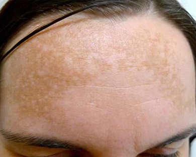 A woman's forehead showing melasma, a type of skin pigmentation.