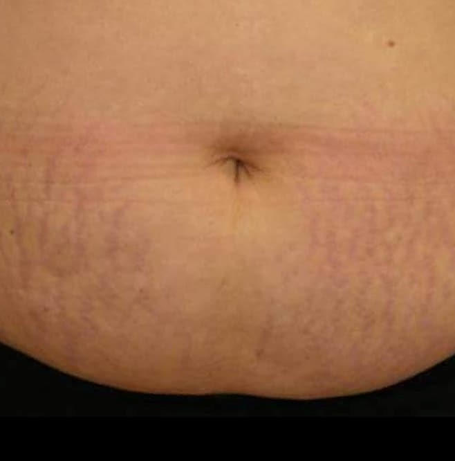 Image of a woman's stomach showing stretchmarks