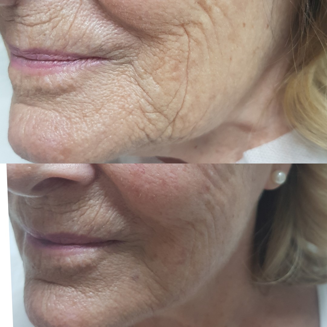 Sunekos skin boosters for lines, wrinkles and hydration