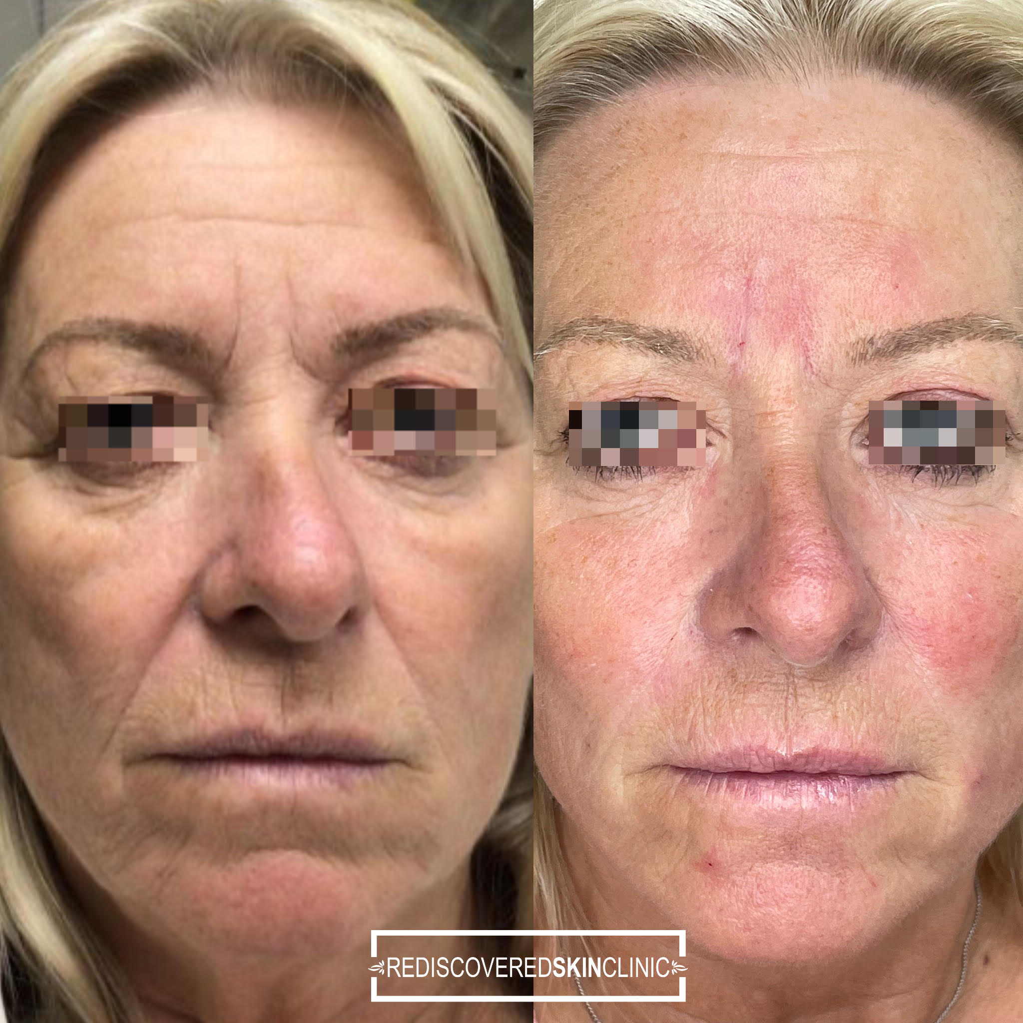 Dermal filler package, before and after