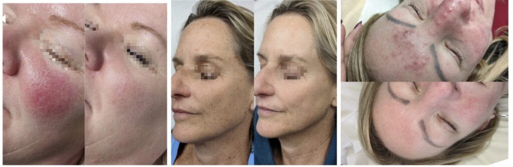 BBL® HERO™, MOXI® & Polynucleotides  from Laser
