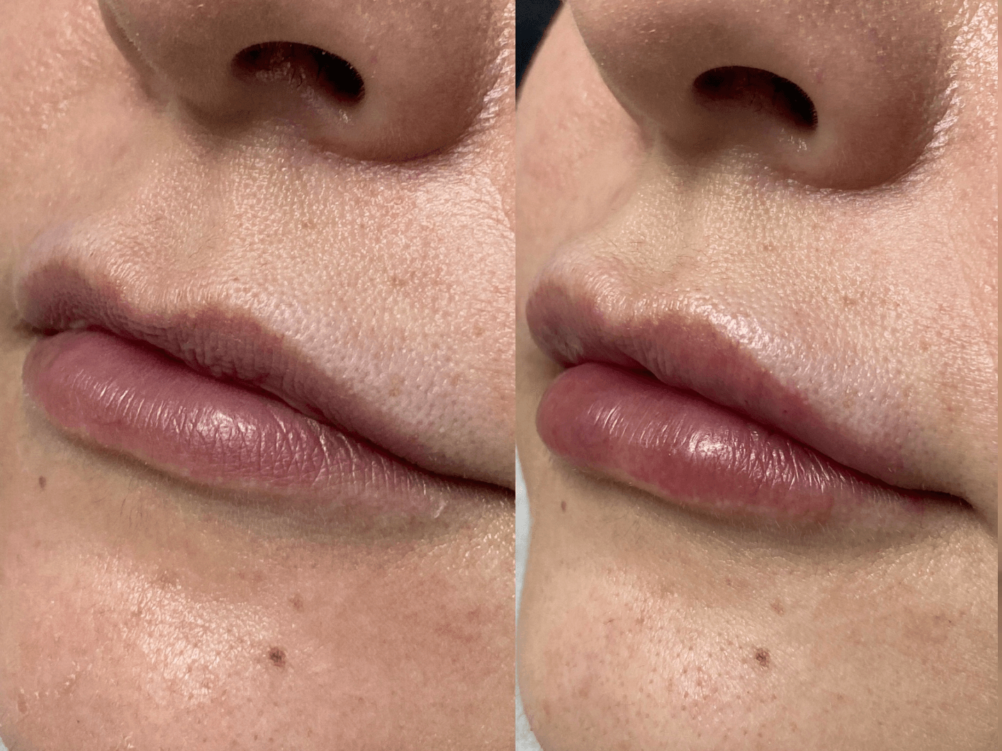 Lips 7