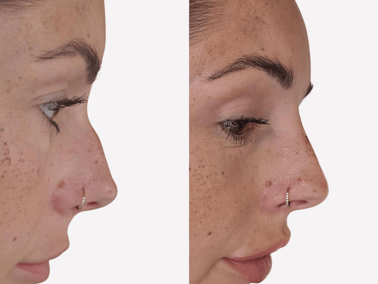 Nose 2A